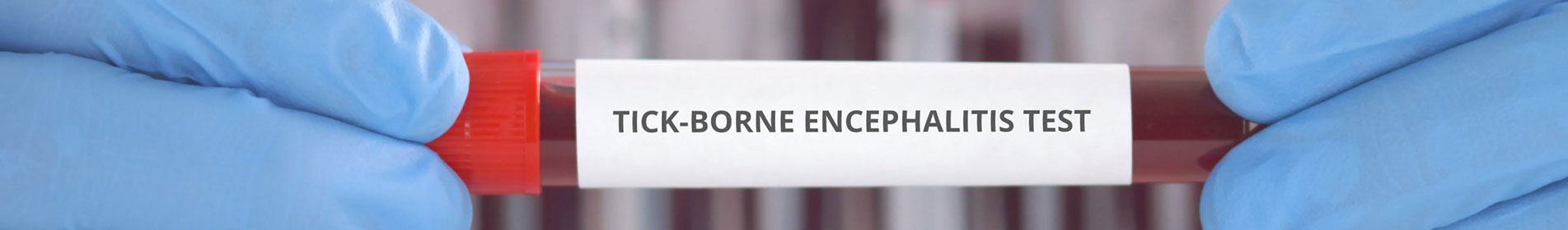 ENcefalite virale - TBE